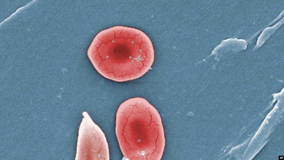 A colorized microcsope image made available by the Sickle Cell Foundation of Georgia via CDC.