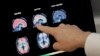 It Seems Like Alzheimer's But Peek Into Brain Reveals a Mimic