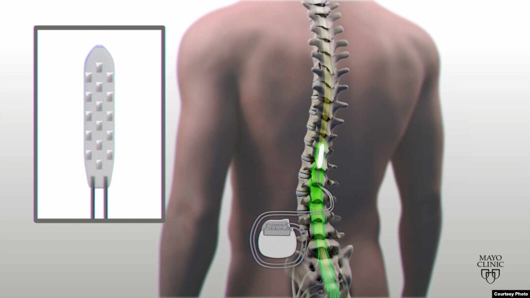Researchers at the Mayo Clinic placed an electronic device near the injury to Chinnock's spinal cord. (Mayo Clinic)