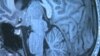 New Research, Funds Raise Hopes for Alzheimer's Cure
