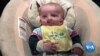 Most Babies Born With Cleft Condition Could Die Without Surgery