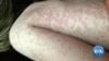Infectious diseases like measles were once considered under control in developed countries, but now the World Health Organization warns that we could be facing a global measles outbreak. 